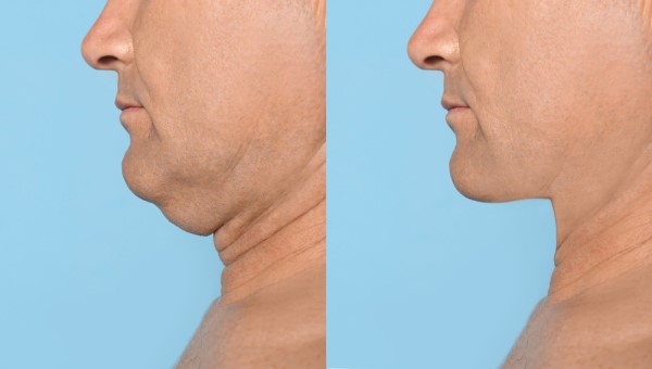 Which Non-Surgical Treatments Work Best for Jowls and Loose Skin Parsons Green?