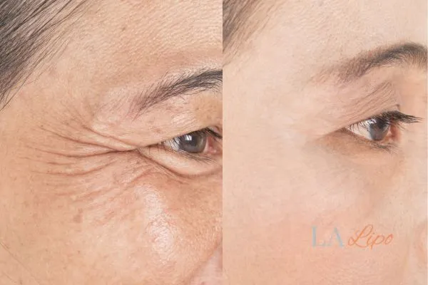 Before and after results of woman - HI-fu wrinkles reduction treatment Parsons Green