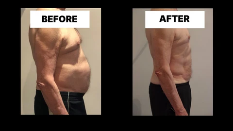 What Symptoms Can Diastasis Recti Cause in Men? Weak Core, Back Pain and Poor Posture Parsons Green